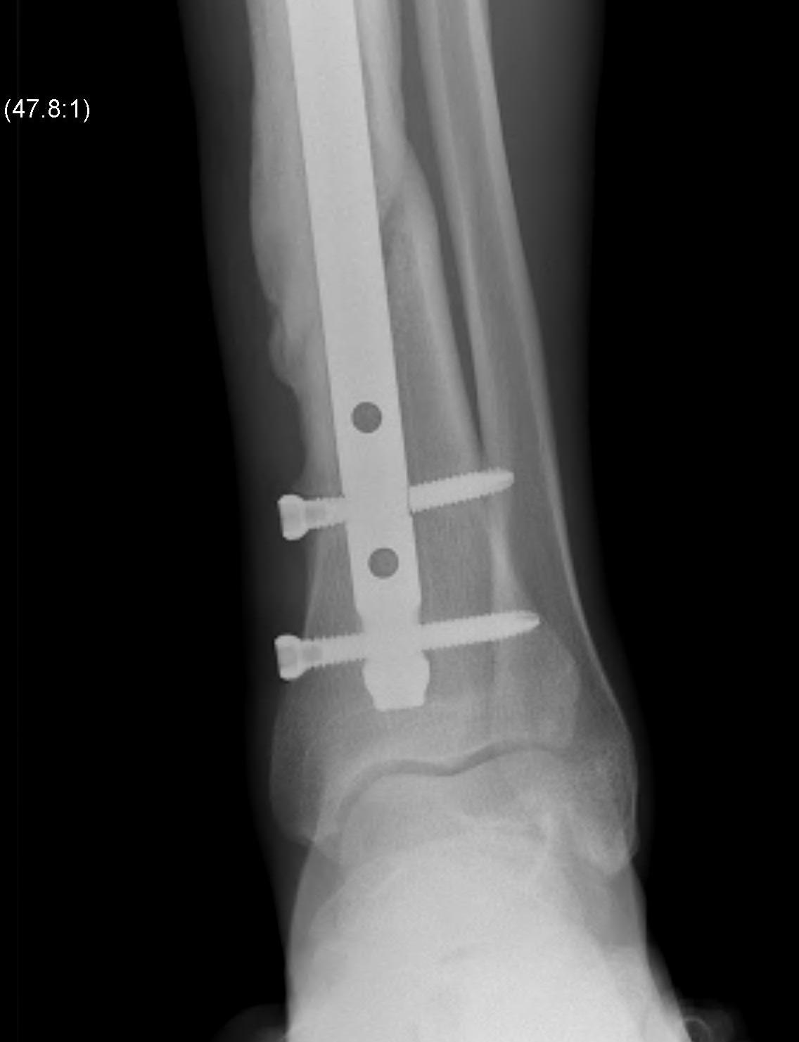 Distal Tibial Nail AP